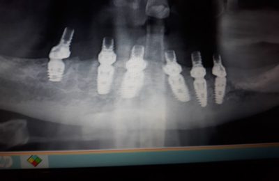 Intervento di Chirurgia Implantare